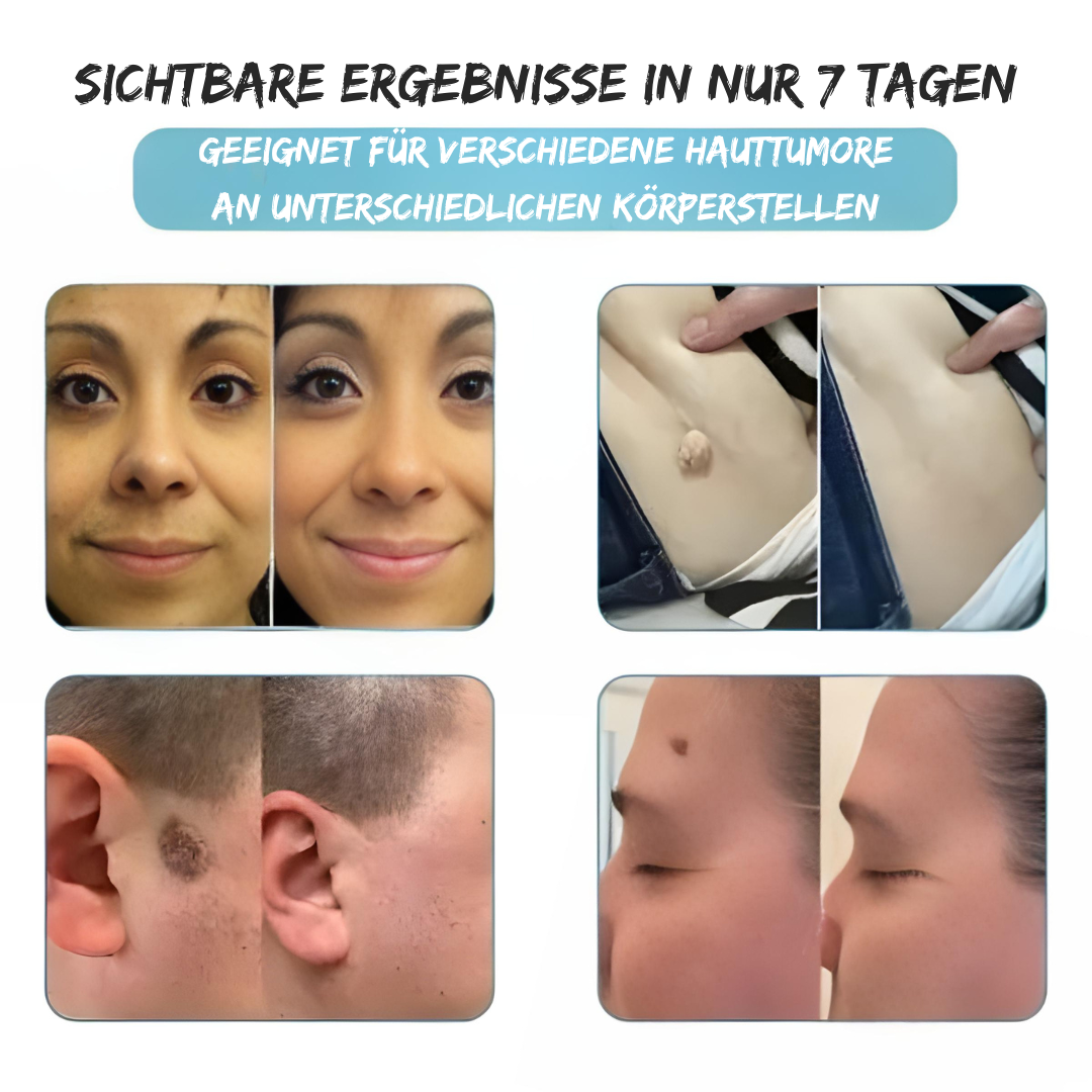 SilkLaser™ | Präzision und Sanftheit in einem