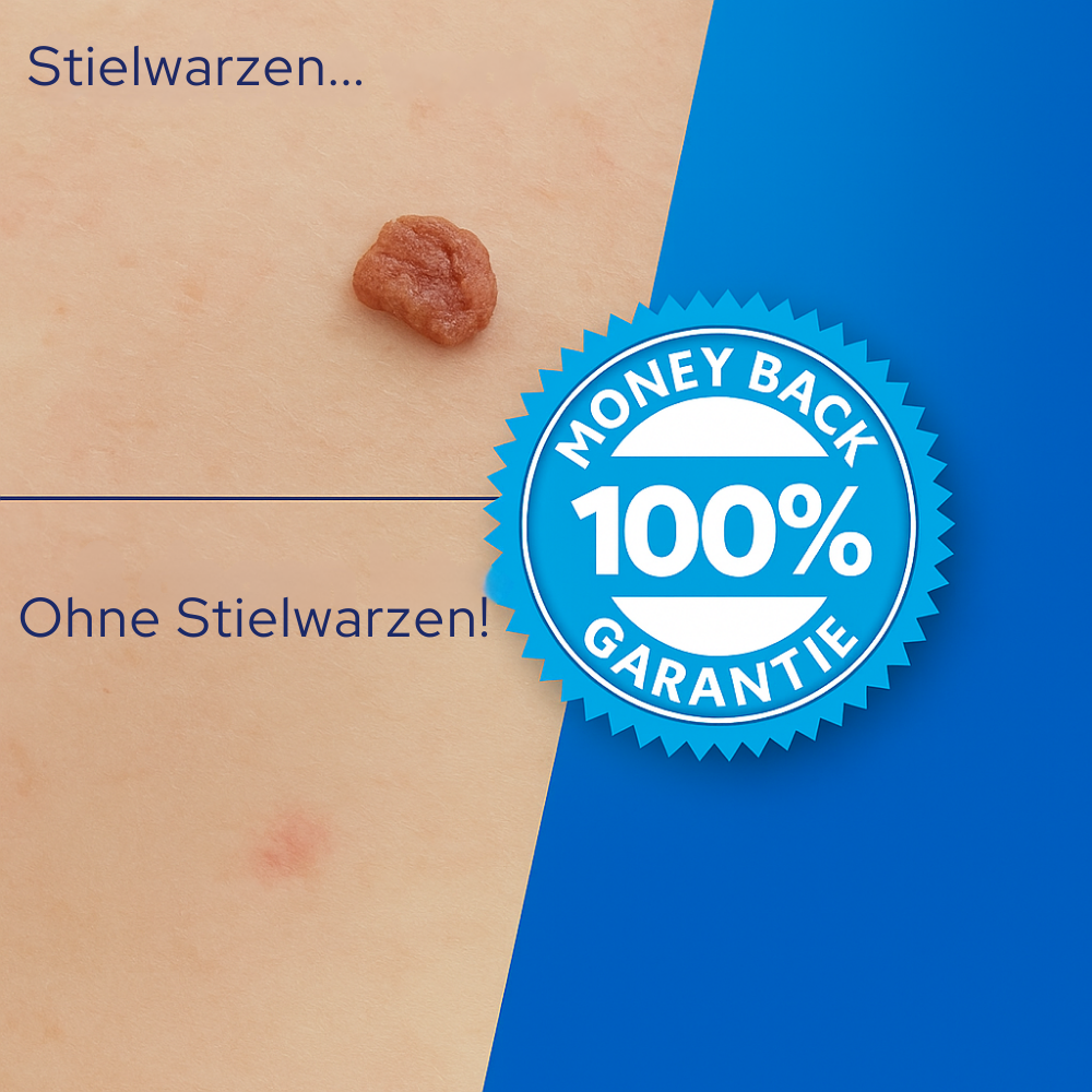 TagErase™ | Schluss mit Stielwarzen