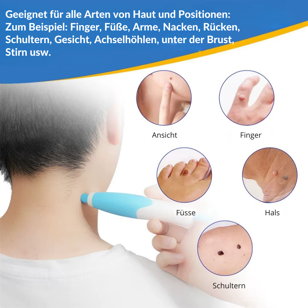 TagErase™ | Schluss mit Stielwarzen
