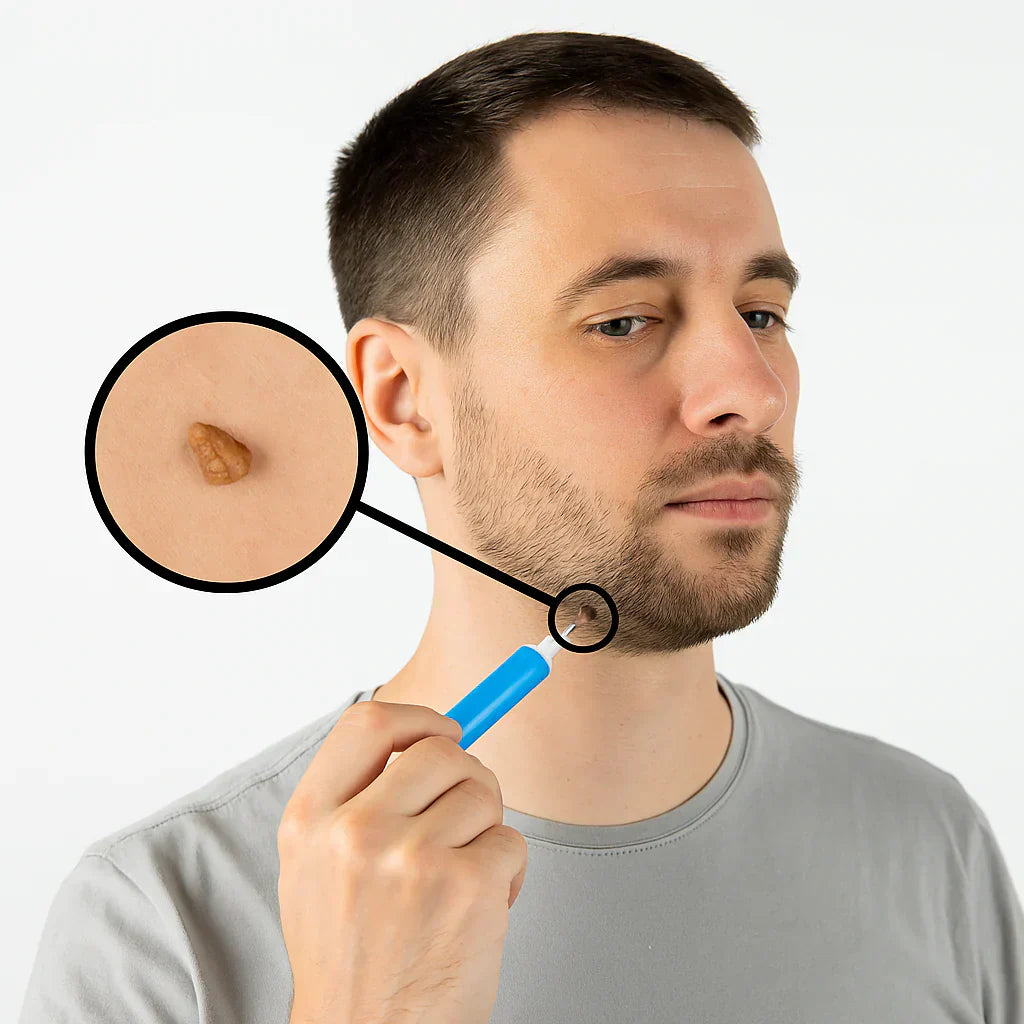 TagErase™ | Schluss mit Stielwarzen